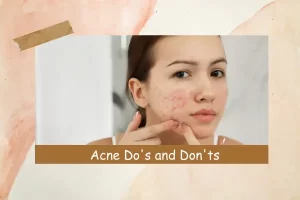 acne do and dont