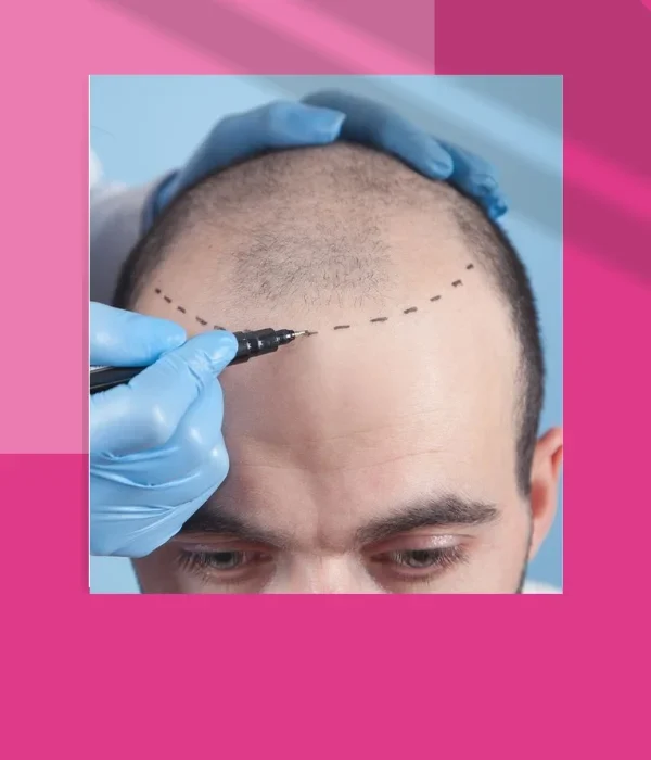 HAIR TRANSPLANT