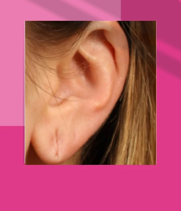 EAR LOBE REPAIR