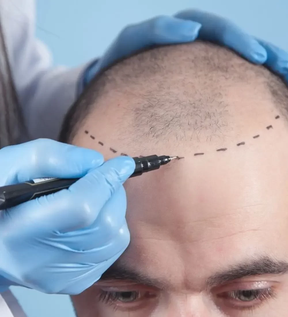 hair transplant procedure