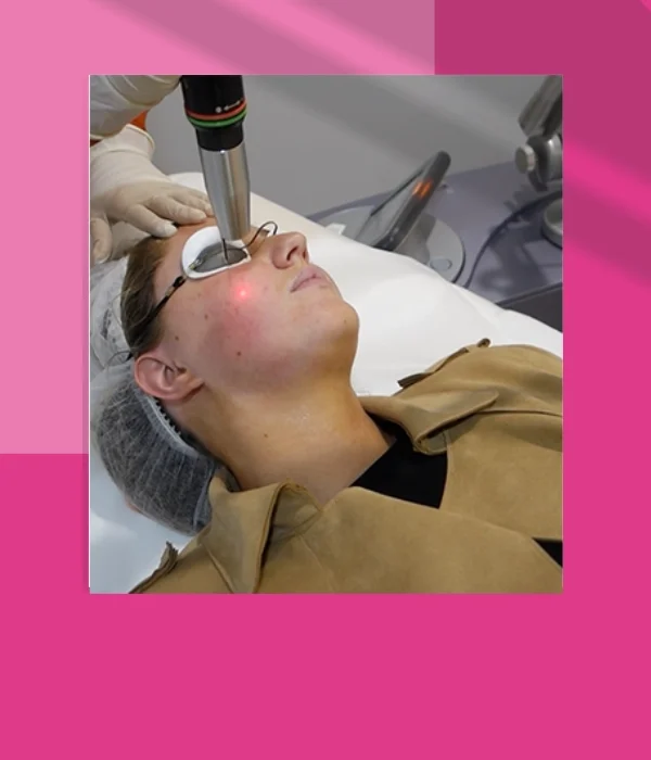 LASER FOR PIGMENTATION