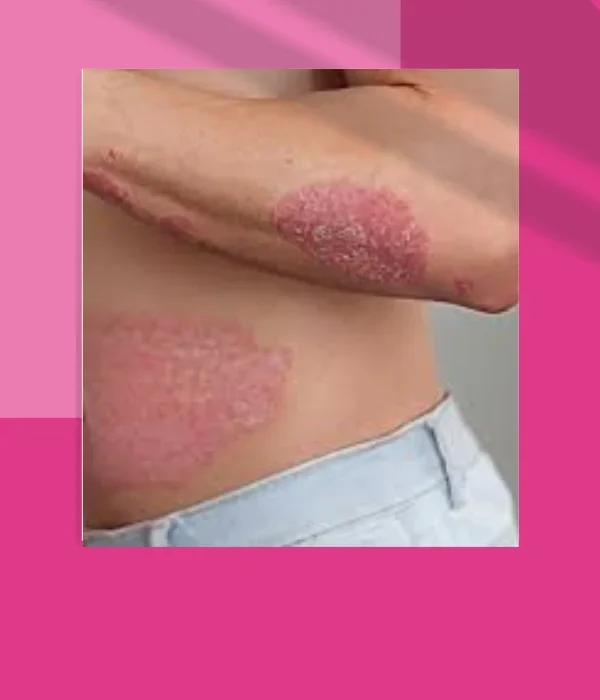 PSORIASIS