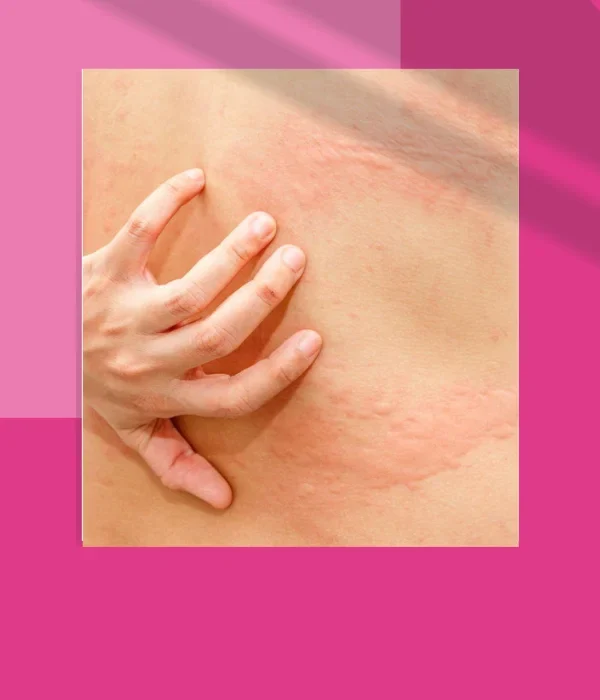 URTICARIA